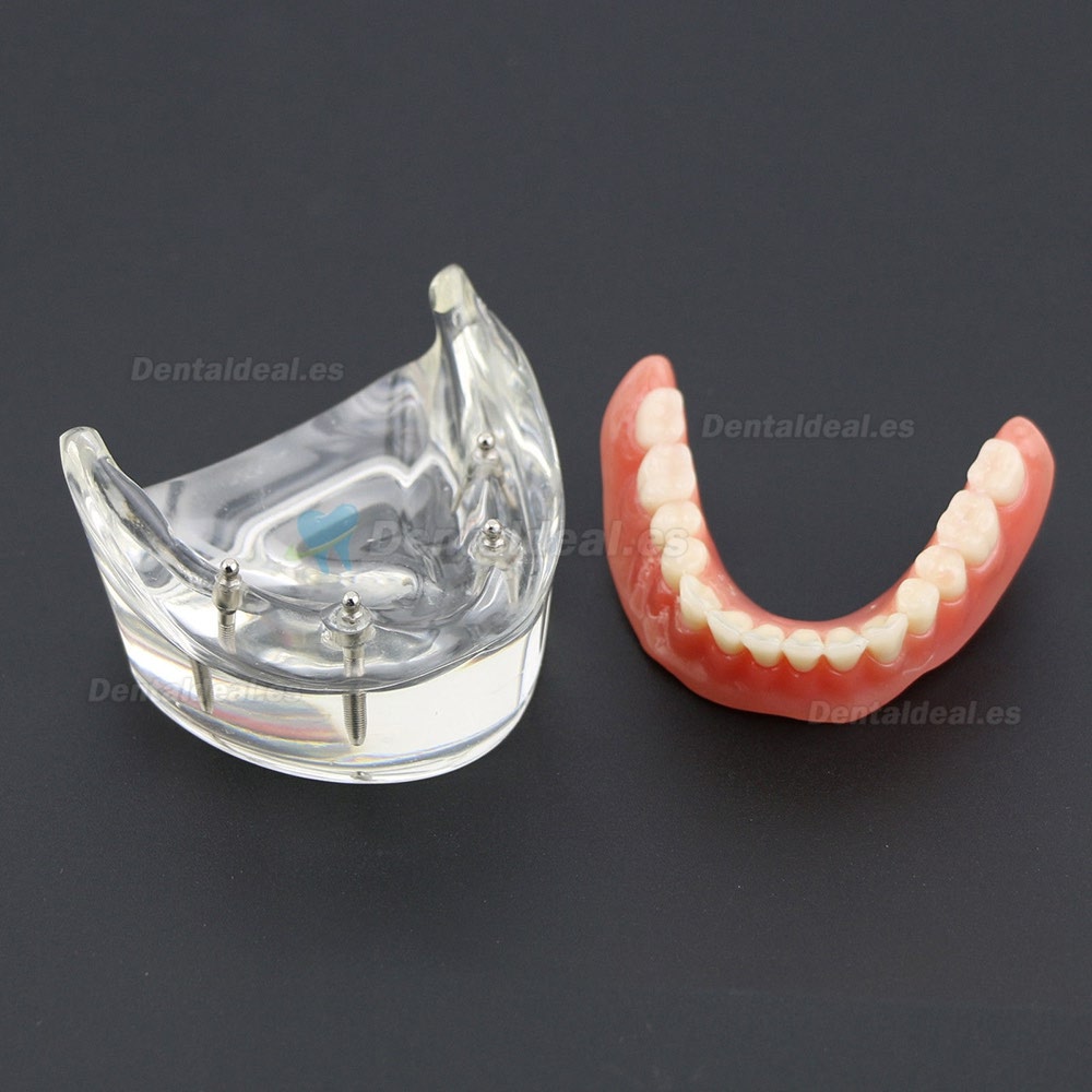 Dientes inferiores dental Modelo de sobredentadura 4 implantes Demostración Modelo 6002 02